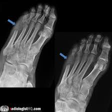 Image result for Osteomyelitis XRay