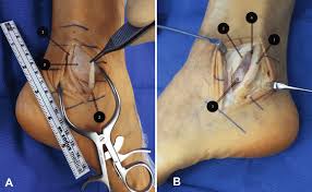 The most common injury to the ankle is a lateral, or inversion sprain. Peroneal Tendon Injury Often Occurs In Conjunction With Lateral Ankle Download Scientific Diagram
