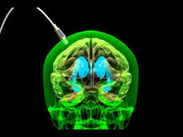 Brain Shunt Insertion Animation Youtube