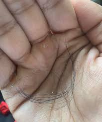 White or black bulb at hair. Does This Look Like Telogen Effluvium I Pulled This Many Hairs Just Running Through My Scalp Note The White Bulbs And How Thin The Hairs Are M 23 Hair