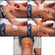 Patellofemoral Taping Pain Relief Mechanisms Lower Extremity Review Magazine