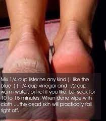 Diy Remove Strech Marks Beauty Remedies Feet Treatment Skin Remedies