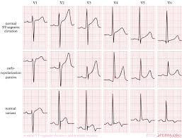 Image result for Early Repolarization