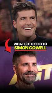 How Botox Altered Simon Cowell's Appearance