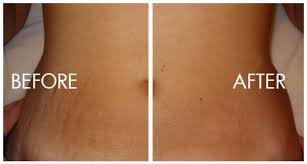 This heat energy helps resolve the redness. Stretch Marks And How To Treat Them