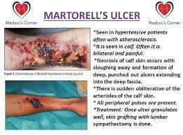 Martorell hypertensive ische­ mic leg ulcer: Facebook
