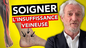 MOH Talk: La varicose pelvienne reste une histoire de veines