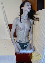 Anorexic nude pics - 69 photo