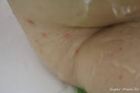 Descoperă acum varietatea noastră impresionantă de subiecte și imagini de calitate. Varicela La Copii ExperienÅ£a NoastrÄ Super Mami Ro