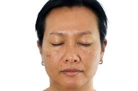 Image result for Melasma