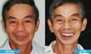 The first Vietnamese doctor repositioning the nerve for the dental implants