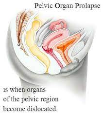 Pin On Vaginal Mesh Lawsuit Blog