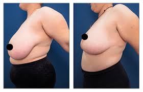 In certain circumstances, basic insurance will cover some of the costs. How To Get Insurance Coverage For Breast Reduction Dr Mowlavi
