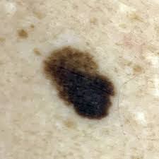 These photos show what melanoma skin cancer looks like and how to spot a cancerous mole. Melanoma In Situ Spot Check Clinic