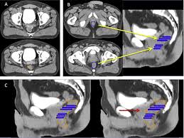 Despite this, pancreatic cancer is among the deadliest types of cancer, which is why it's extremely important to know and recogni. Estro Acrop Consensus Guideline On Ct And Mri Based Target Volume Delineation For Primary Radiation Therapy Of Localized Prostate Cancer Radiotherapy And Oncology