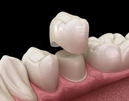 However, your plan may only cover certain kinds of crowns. Root Canal And Crown Cost In Los Angeles Price Of Root Canal Crown
