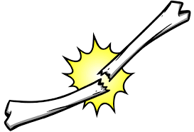 Choose from over a million free vectors, clipart graphics, vector art images, design templates, and illustrations created by artists worldwide! Bone Healing Therapy For Nf1 Fractures Vumc Reporter Vanderbilt University