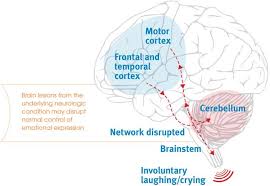 Pseudobulbar Affect Pba Steemit