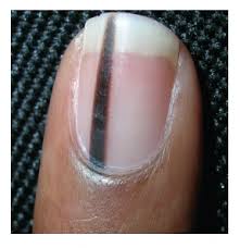 Image result for Acral lentiginous melanoma nail