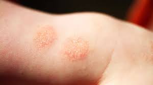 Image result for Eczema nummulare