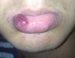 Häufig entzünden sich kleine stellen der mundschleimhaut, brennen, jucken oder bluten sogar. Lippe Aufgeplatzt Was Sollte Man Tun Innenseite Korper Beauty Gesicht