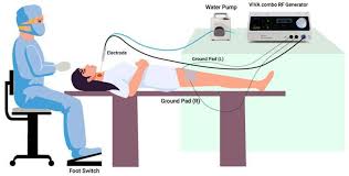 Image result for Radiofrequency Surgery