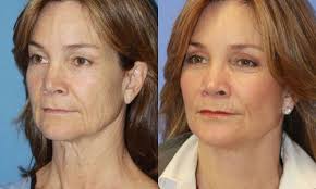 Face Lift Before And After Photos Facelifts Remove Wrinkles Around Your Mouth Eyes And Cheeks To G Natural Face Lift Facial Yoga Exercises Face Yoga Exercises