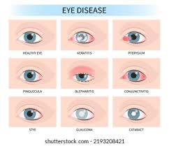 Image result for Scleritis