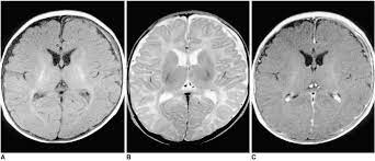Figure Shaken Baby Syndrome Mri Chronic Statpearls Ncbi Bookshelf