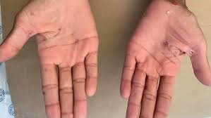 Image result for Secondary Syphilis