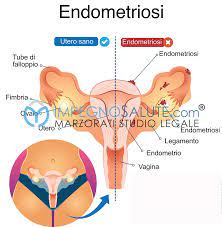 Endometriosi interna ed endometriosi esterna: Endometriosi Patologia Pelvica Avvocato Errore Medico E Malasanita