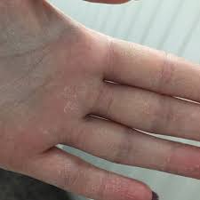 Haut An Den Handinnenflachen Pellt Sich Was Tun Gesundheit Und Medizin Hand