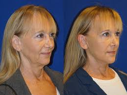 Deep Plane Facelift Santa Barbara