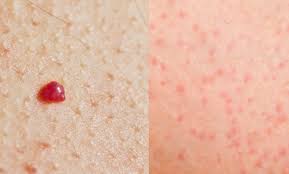 If breast cancer is diagnosed at an early enough stage, it's treatable. What Do Red Spots On Skin Mean 13 Skin Spots Bumps Pictures Scoopsky