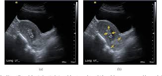 Ultrasound obstet gynecol sent rpoc. Figure 2 From Retained Products Of Conception An Atypical Presentation Diagnosed Immediately With Bedside Emergency Ultrasound Semantic Scholar