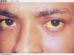 La sindrome di gilbert è generalmente determinata da un'anomalia genetica ereditaria. Bilirubina Alta