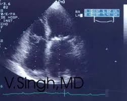 Intravascular Ultrasound Information | Mount Sinai - New York