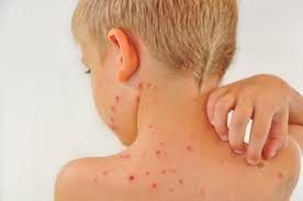 Image result for shingles in children
