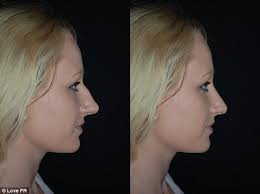 Shy girl Fiona Todd was so paranoid about her looks she underwent a nose  job