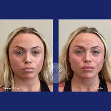 Swipe to see these amazing before and afters of this stunning facial  balancing treatment using filler! 💉 These results truly speak for  themselves✨ Treatment: -Chin for definition -Cheeks/midface for harmony and  lift -