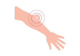 Ovarian cancer is a common gynecologic cancer in the u.s. 9 Causes For Hard Lump On Forearm Buoy