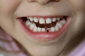 Losing Baby Teeth Are Red Spots On The Gums Normal Ask