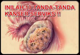 Iaitu dikawasan paling bawah bahagian rahim. 10 Tanda Tanda Kanser Serviks Yang Ramai Tak Tahu Wanita Wajib Baca Dan Share Kan Radio Karat