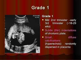 Grade 1grade 1 Grade 1grade 1 Mid 2nd Trimester Earlymid 2nd Trimester Early 3rd Trimester 18 293rd Trimester Placenta Ultrasound Obstetric Ultrasound