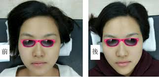 V型塑臉, 做五次的效果! 獲得客人的授權, 所以貼上來分享!