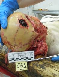 Эпидуральная гематома  autopsy :: morbid :: xxx-files  funny cocks & best  free porn: r34, futanari, shemale, hentai, femdom and fandom porn