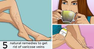 Jan 11, 2020 · 1. Top 5 Natural Remedies To Get Rid Of Varicose Veins Naturally