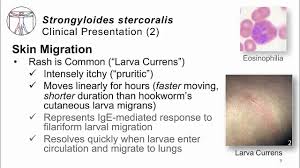 Image result for Strongyloides