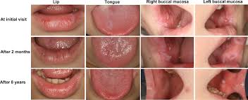 Image result for lichen planus on tongue)