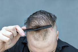 Dans le cas de la perte de cheveux. Alopecie Tout Savoir Sur La Perte De Cheveux Conseils Sante